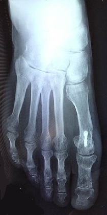 orthoplastie